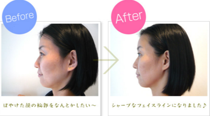 小顔フェイシャル